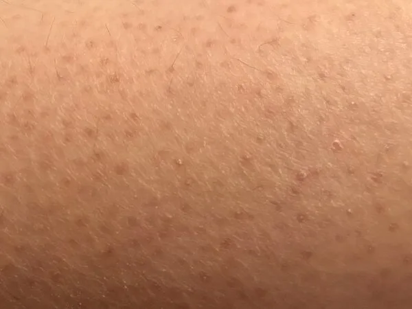 Keratosis pilaris oorzaak